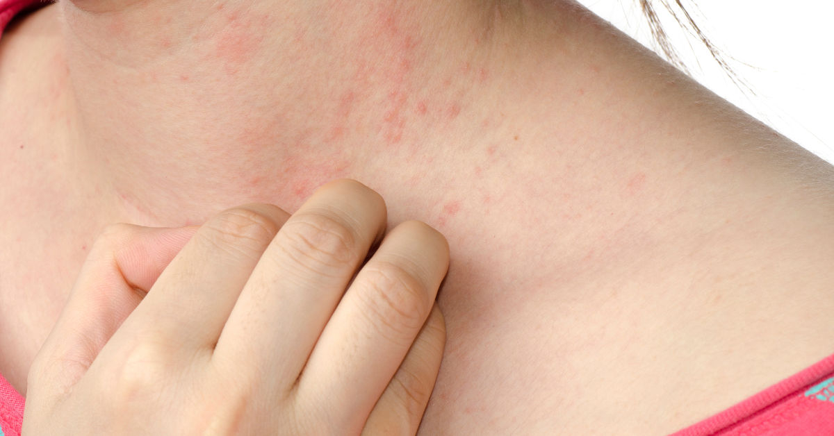Biểu hiện bị dị ứng thực phẩm