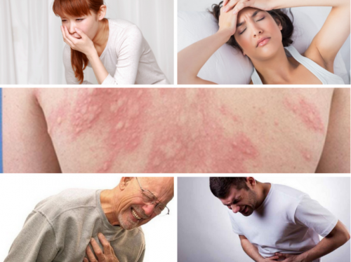 Các biểu hiện có thể gặp trong sốc phản vệ