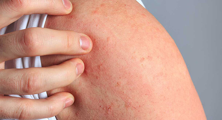 Dị ứng là một tình trạng phổ biến, do phản ứng miễn dịch với dị nguyên